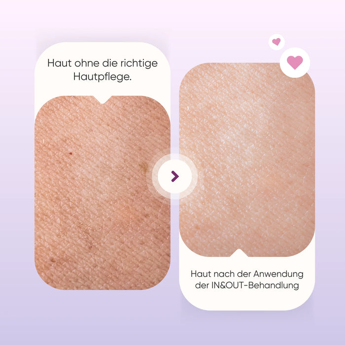 Close-up skin comparison: without the right care and after using the IN & OUT anti-wrinkle facial treatment